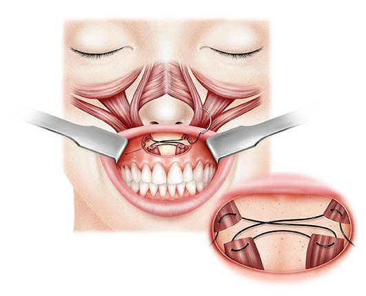 surgery illustration techniques